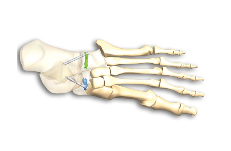 The IO-Fix from Extremity Medical